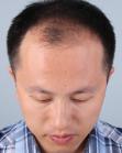 Before Hair Transplant&nbsp;Front